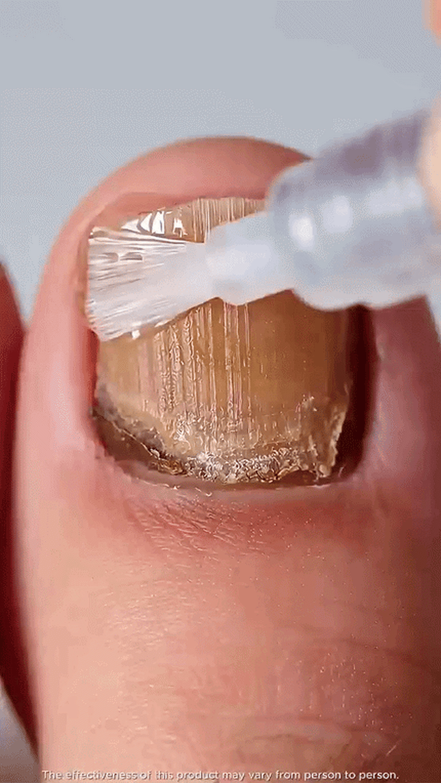 nail fungus treatment pen toenail fingernail - Precision Brush-On Format