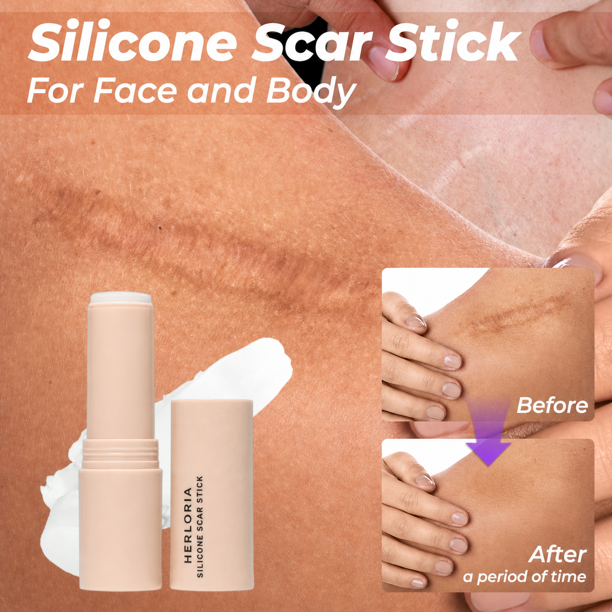 Herloria silicone scar stick for face and body