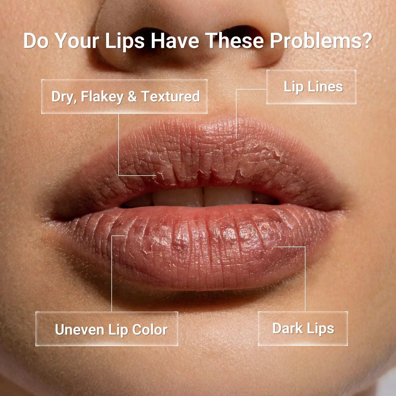 Dry and textured lip concerns